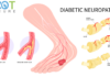 Understanding Diabetic Peripheral Neuropathy