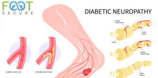Understanding Diabetic Peripheral Neuropathy