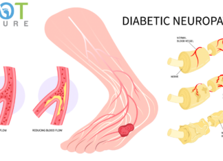 Understanding Diabetic Peripheral Neuropathy