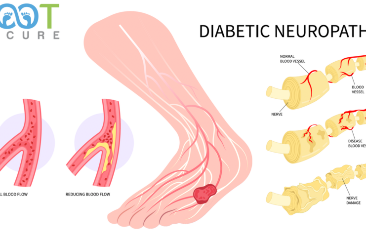 Understanding Diabetic Peripheral Neuropathy